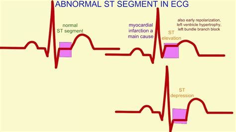 abnormal ekg results|what does a normal ekg look like.